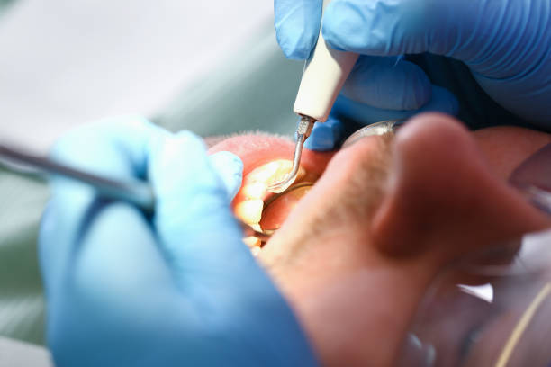 Best Emergency Dental Extractions in Columbus, IN