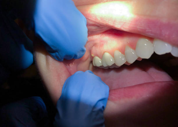 Best Emergency Dentist for Knocked-Out Tooth in Columbus, IN